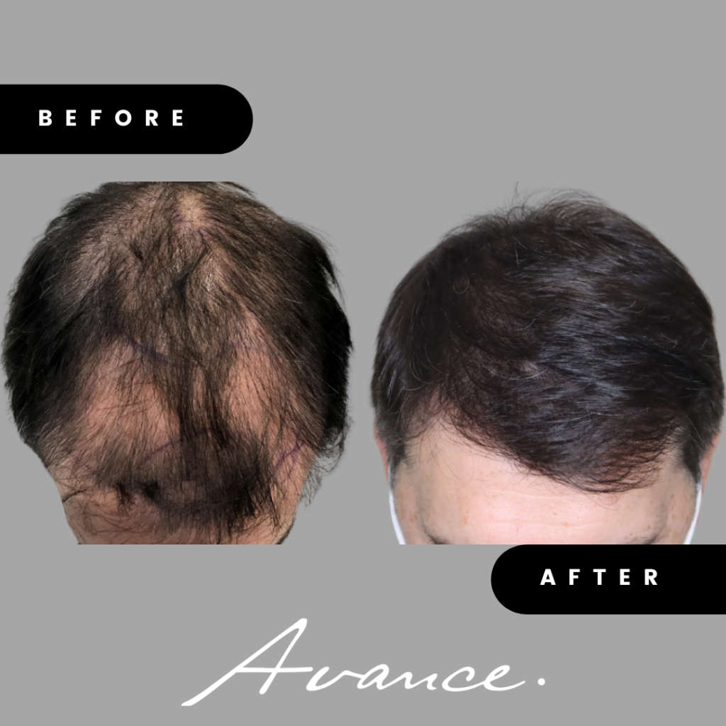 Before and After - Hair Transplant