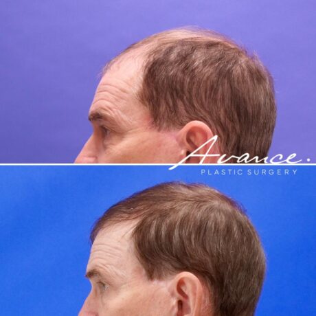 Antes y después - Cabello