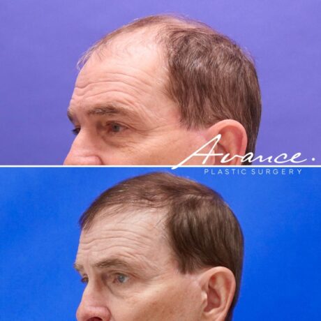 Antes y después - Cabello
