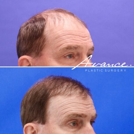 Antes y después - Cabello