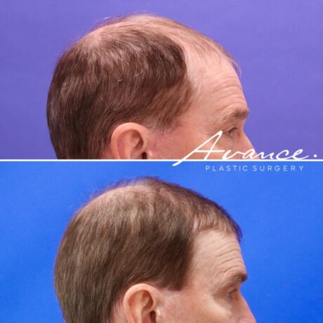 Antes y después - Cabello