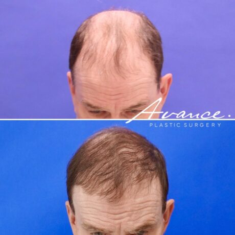 Antes y después - Cabello